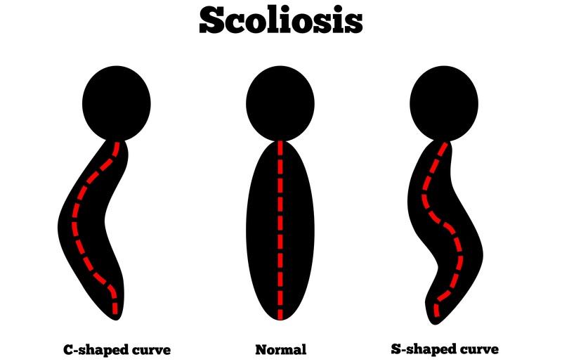 Daphne, AL scoliosis treatment